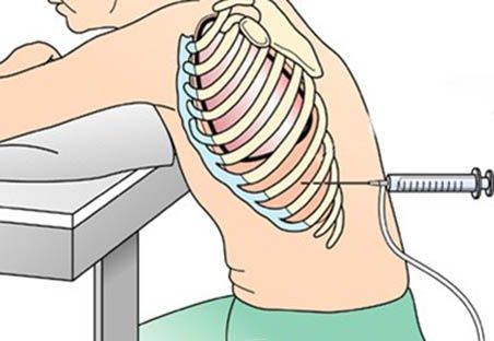 Как выкачивают жидкость из легких