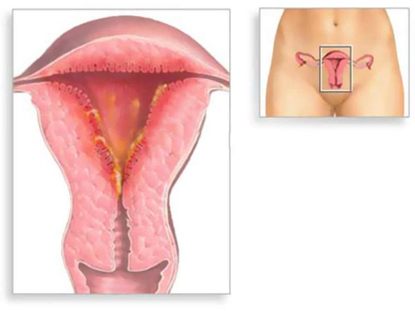 endometrit s