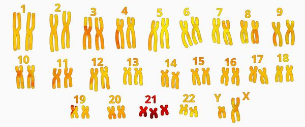 Лишняя 21-ая хромосома при синдроме Дауна