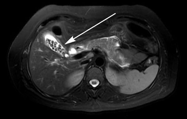 МРТ-снимок желчнокаменной болезни