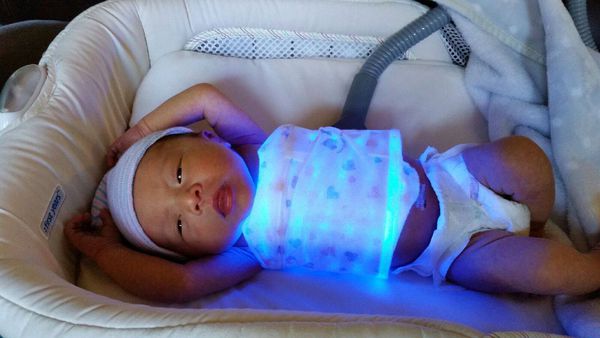 Установка с фиброоптическими волокнами для лечения желтухи у новорождённых