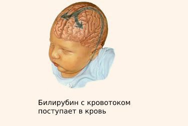 Физиологическая желтуха новорожденных что это