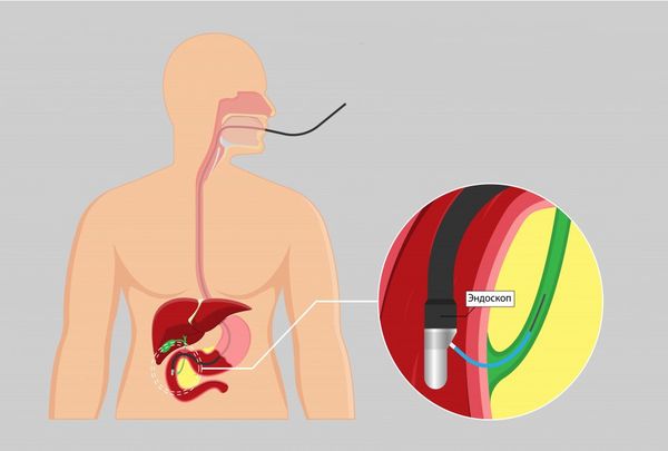Эндоскопическая ретроградная холангиопанкреатография (ЭРХПГ) Эндоскопическая ретроградная холангиопанкреатография (ЭРХПГ)