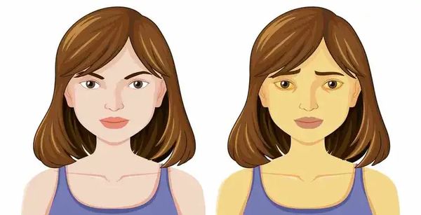 Признаки желтухи Признаки желтухи