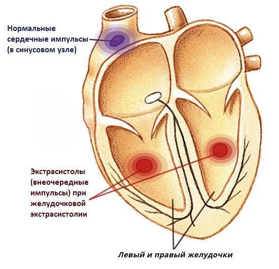 Экстрасистолы в левом и правом желудочках сердца
