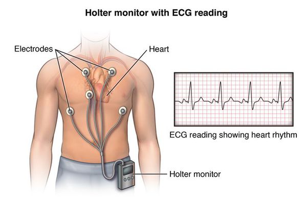 Холтеровское мониторирование сердца