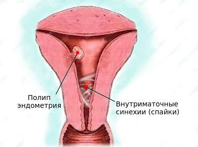 polip endometriya i vnutrimatochnye spayki s