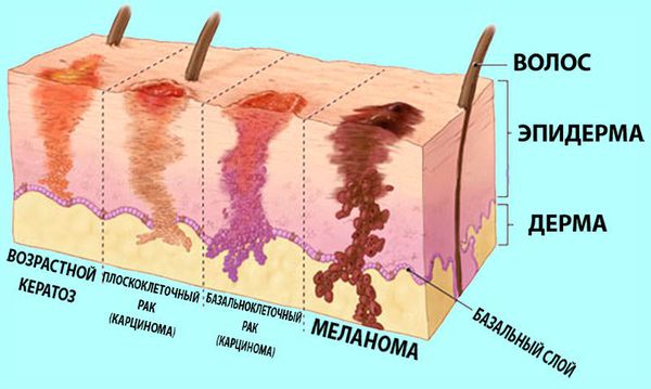 Злокачественные новообразования кожи (опухоли, рак кожи): причины, симптомы  и лечение в статье онколога Лисовой В. А.