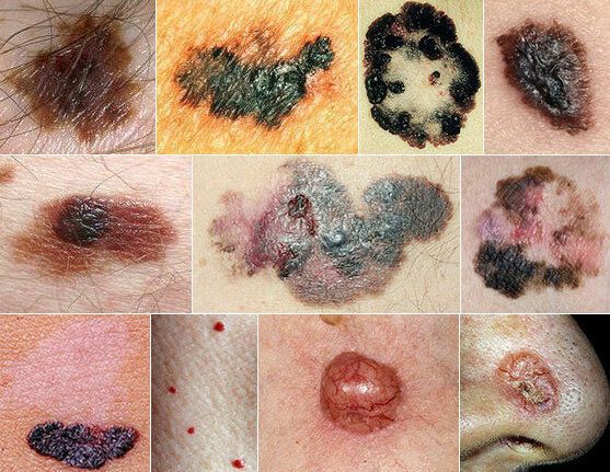 Злокачественные новообразования кожи (опухоли, рак кожи): причины, симптомы  и лечение в статье онколога Лисовой В. А.