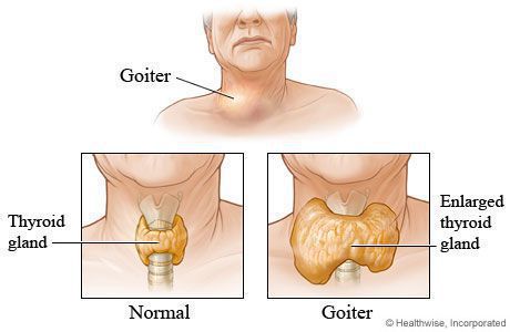 щитовидная железа Базедова болезнь болезнь Грейвса зоб диффузный токсический