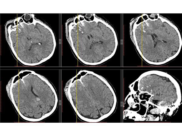 КТ головного мозга в первые сутки после поступления