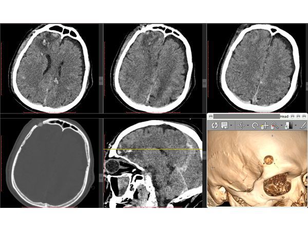 Кт головного мозга естественное контрастирование. Кт мозга вредно. Магнитно резонансные томограммы головного мозга. Противопоказания к кт и мрт. Кт головного мозга с контрастированием.