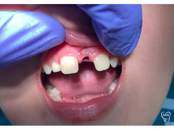 Фото после удаления Фото после удаления