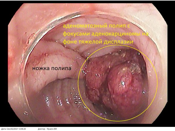 Статья «Анальный зуд (зуд в заднем проходе)»