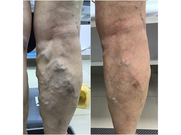 Задняя часть правой ноги до и через 2 месяца после лечения