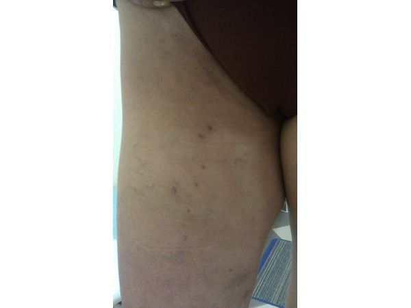 4 месяца после лечения 