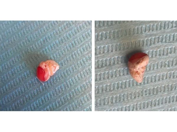 Удалённый зачаток сверхомплектного зуба Удалённый зачаток сверхомплектного зуба