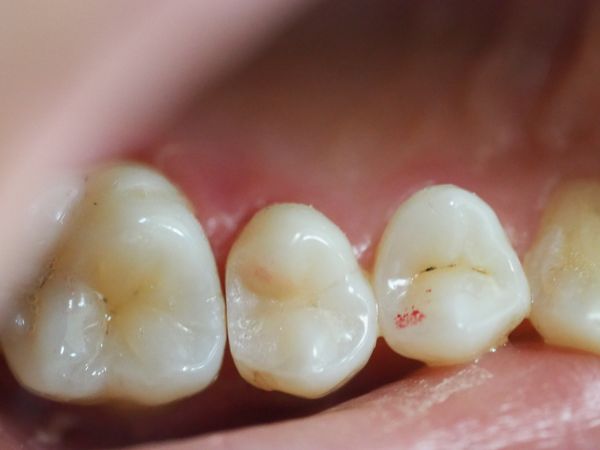 Внешний вид пломбы