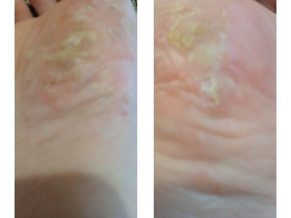 Состояние до и после лечения Состояние до и после лечения