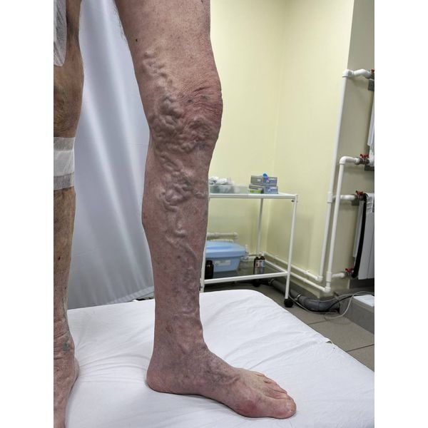 До операции