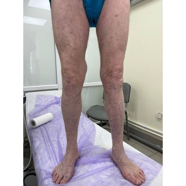 Через 2 месяца после операции