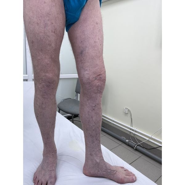 Через 2 месяца после операции