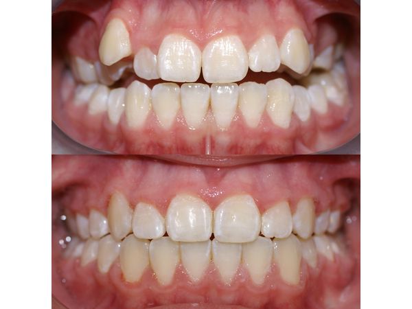 Зубы до и после лечения: вид спереди