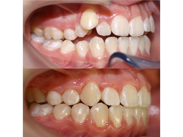 Зубы до и после лечения: вид слева