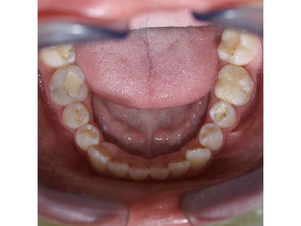 Нижний ряд зубов до лечения