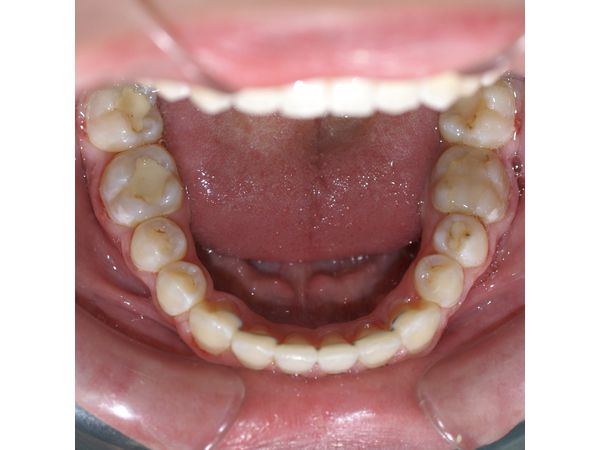 Нижний ряд зубов после лечения