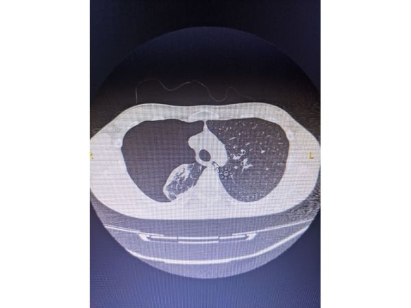 КТ органов грудной клетки от 28 января КТ органов грудной клетки от 28 января