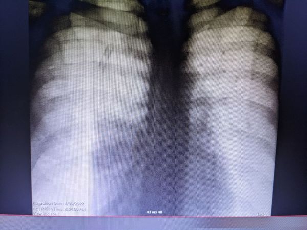 Отсутствие эффекта после дренирования правой плевры в сочетании с вакуум-аспирацией Отсутствие эффекта после дренирования правой плевры в сочетании с вакуум-аспирацией