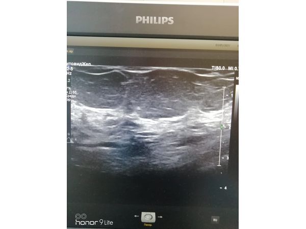 УЗ-картина после лечения УЗ-картина после лечения