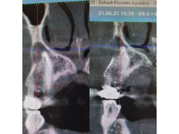 Восстановление кортикальной пластинки Восстановление кортикальной пластинки