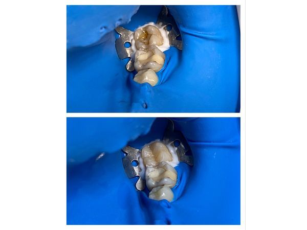 До и после лечения