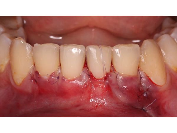 Десна после третьей операции Десна после третьей операции