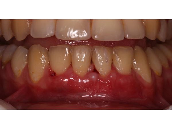 Через 14 дней после снятия швов Через 14 дней после снятия швов