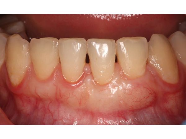 Через 2 месяца после операции Через 2 месяца после операции