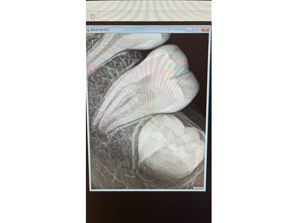 Рентгенограмма зачатка 38-го зуба