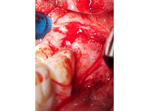 Откидывание слизисто-надкостничного лоскута