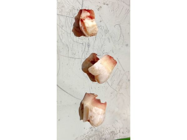 Части удалённого зуба