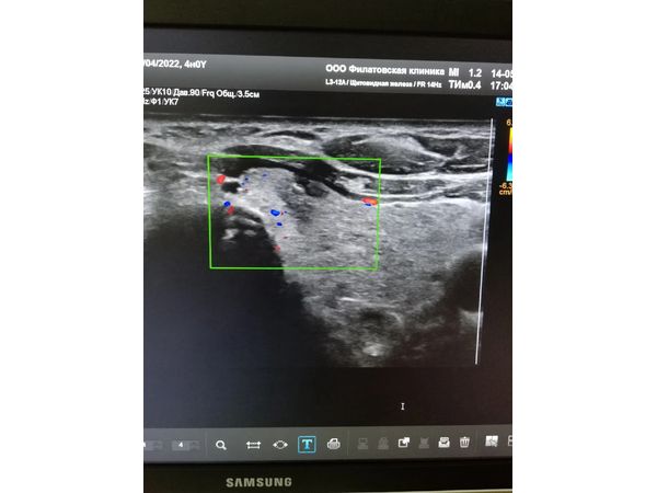 Узел с множественными кальцинатами в левой доле Узел с множественными кальцинатами в левой доле