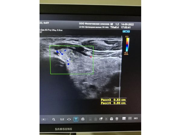 TI-RADS 5 в левой доле TI-RADS 5 в левой доле