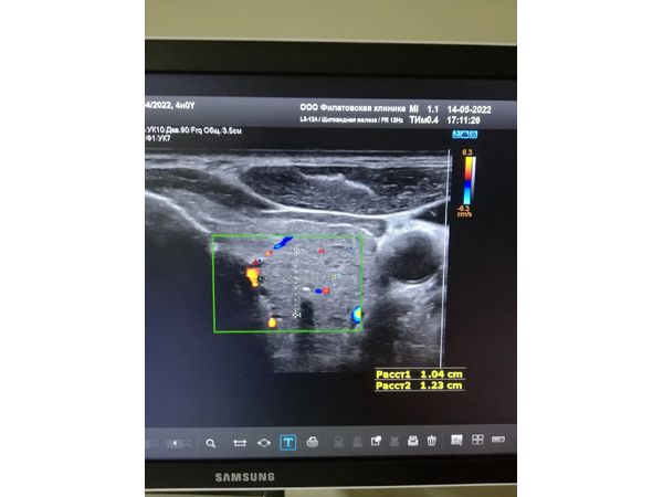 TI-RADS 4б в левой доле TI-RADS 4б в левой доле
