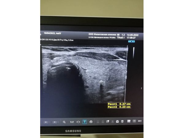 Крупный кальцинат Крупный кальцинат