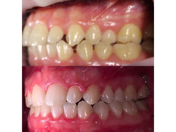 До и после лечения: вид справа До и после лечения: вид справа