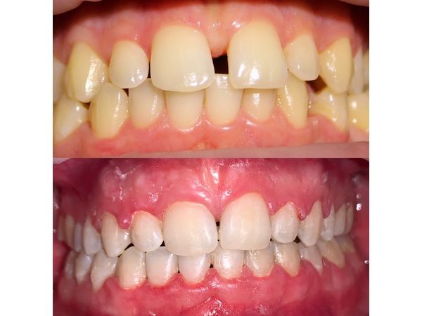 До и после лечения: вид спереди До и после лечения: вид спереди