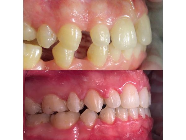 До и после лечения: вид слева До и после лечения: вид слева