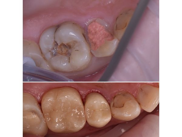 До и после лечения До и после лечения