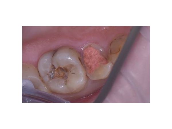 Зубы 1.6 и 1.5 до лечения Зубы 1.6 и 1.5 до лечения